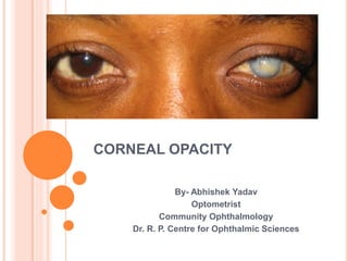 CORNEAL OPACITY
By- Abhishek Yadav
Optometrist
Community Ophthalmology
Dr. R. P. Centre for Ophthalmic Sciences
 
