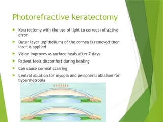 corneal refractive surgeries presenters | PPTX