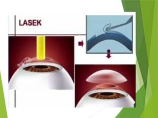 corneal refractive surgeries presenters | PPTX