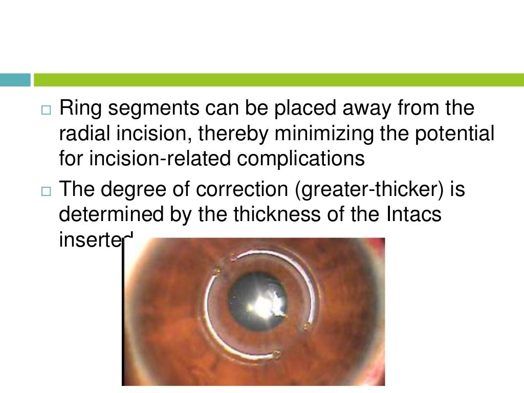 Corneal rings