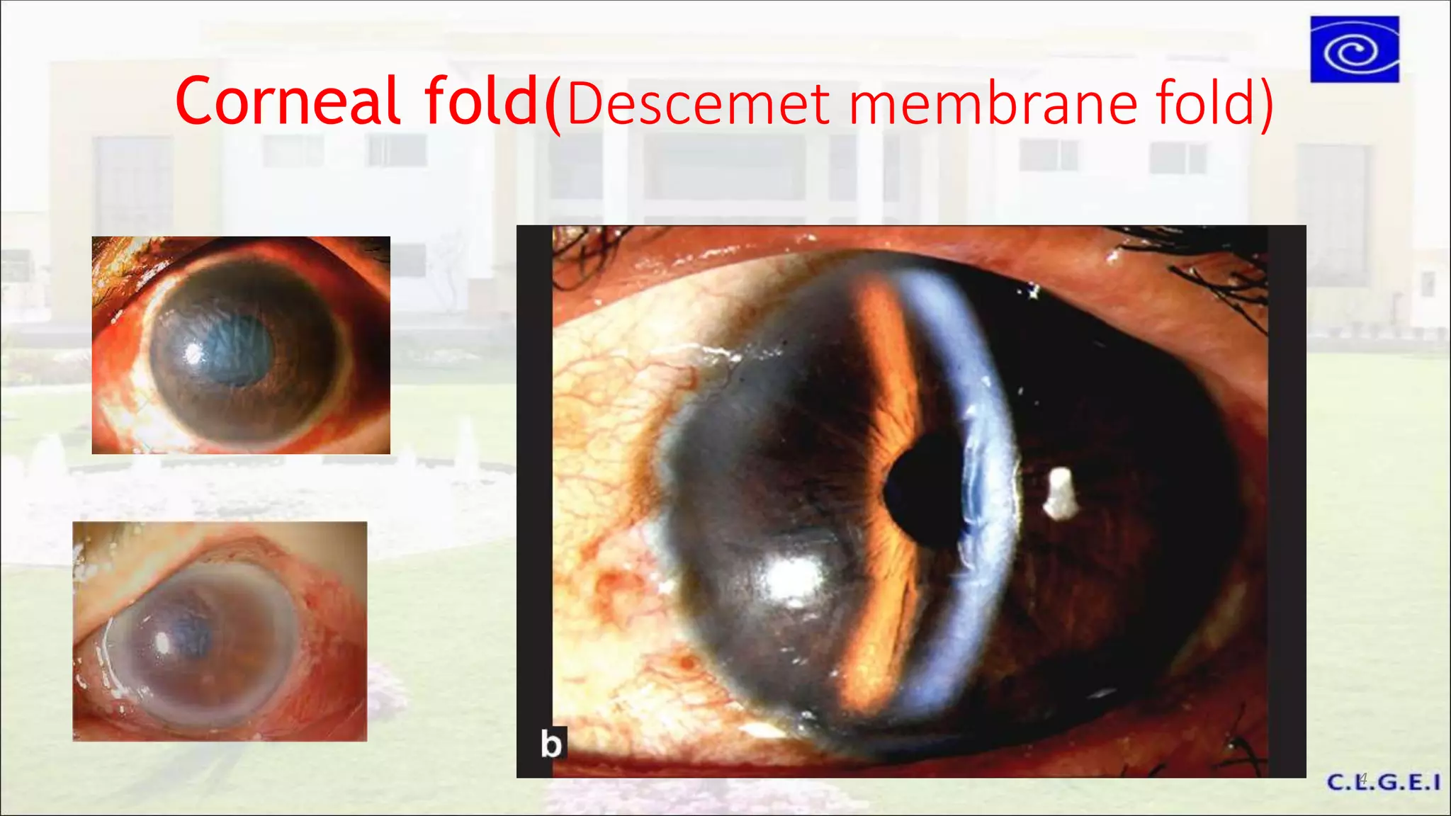 Corneal fold(Descemet membrane fold)
4
 