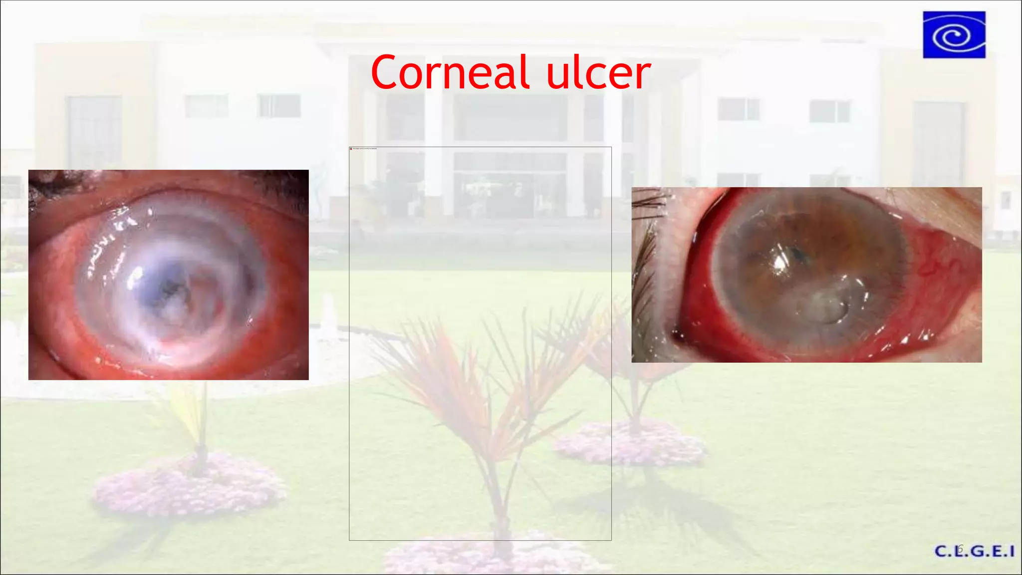 Corneal ulcer
6
 