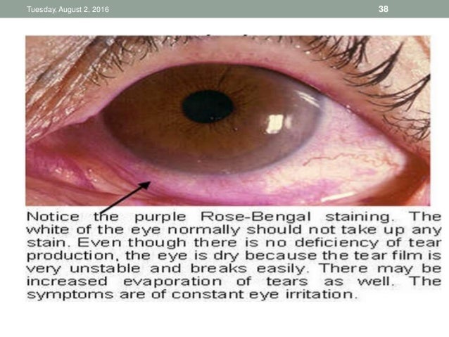 Corneal Staining Procedure Corneal Staining Procedure