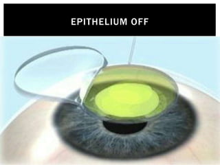 Corneal Topography Corneal Cross Linking Pediatric and Presbyopic ...
