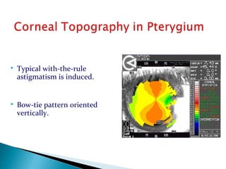  Typical with-the-rule
astigmatism is induced.
 Bow-tie pattern oriented
vertically.
 