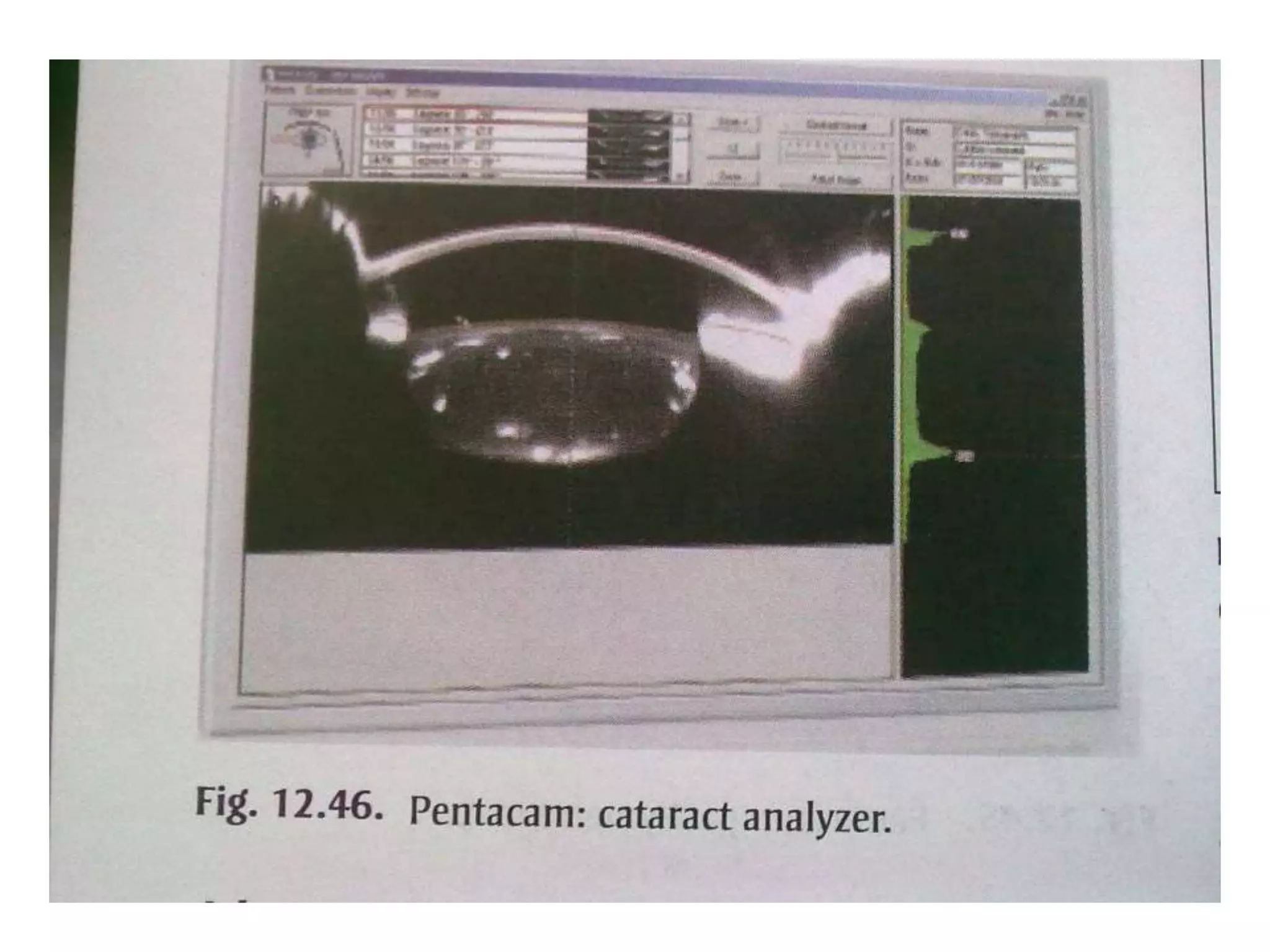 Corneal topography wavefront analysis | PPTX