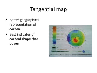 Corneal topography wavefront analysis | PPTX