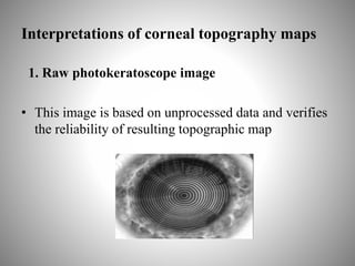 Interpretations of corneal topography maps
1. Raw photokeratoscope image
• This image is based on unprocessed data and verifies
the reliability of resulting topographic map
 