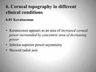 6. Corneal topography in different
clinical conditions
6.01 Keratoconus
• Keratoconus appears as an area of increased corneal
power surrounded by concentric area of decreasing
power
• Inferior-superior power asymmetry
• Skewed radial axis
 