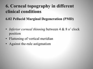 6. Corneal topography in different
clinical conditions
6.02 Pellucid Marginal Degeneration (PMD)
• Inferior corneal thinning between 4 & 8 o’ clock
position
• Flattening of vertical meridian
• Against the-rule astigmatism
 