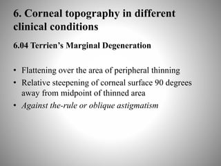 6. Corneal topography in different
clinical conditions
6.04 Terrien’s Marginal Degeneration
• Flattening over the area of peripheral thinning
• Relative steepening of corneal surface 90 degrees
away from midpoint of thinned area
• Against the-rule or oblique astigmatism
 