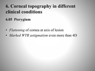 6. Corneal topography in different
clinical conditions
6.05 Pterygium
• Flattening of cornea at axis of lesion
• Marked WTR astigmatism even more than 4D
 