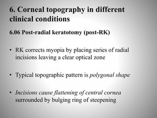 6. Corneal topography in different
clinical conditions
6.06 Post-radial keratotomy (post-RK)
• RK corrects myopia by placing series of radial
incisions leaving a clear optical zone
• Typical topographic pattern is polygonal shape
• Incisions cause flattening of central cornea
surrounded by bulging ring of steepening
 