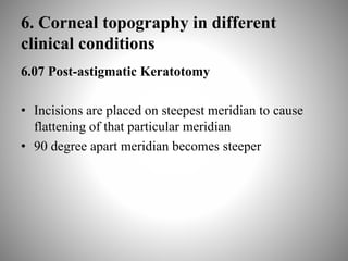 6. Corneal topography in different
clinical conditions
6.07 Post-astigmatic Keratotomy
• Incisions are placed on steepest meridian to cause
flattening of that particular meridian
• 90 degree apart meridian becomes steeper
 