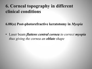 6. Corneal topography in different
clinical conditions
6.08(a) Post-photorefractive keratotomy in Myopia
• Laser beam flattens central cornea to correct myopia
thus giving the cornea an oblate shape
 