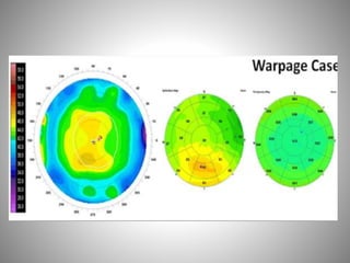 Corneal topography