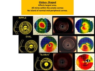 MORPHOLOGY OF ECTASIA
Nipple - Shaped
Small, central ectasia
Less than 5.0mm
High WTR astigmatism
360O
normal peripheral cornea
Oval- Shaped
Varying degree of Inferior mid-periphery steepening.
Island of normal/flatter than normal cornea exactly
located 180O
away .
Globus- Shaped
Affects largest area.
All mires within the ectatic cornea
No island of normal mid-peripheral cornea.
 