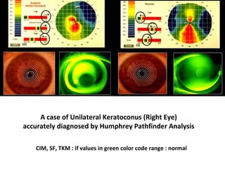 A case of Unilateral Keratoconus (Right Eye)
accurately diagnosed by Humphrey Pathfinder Analysis
CIM, SF, TKM : if values in green color code range : normal
 