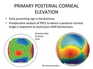 PRIMARY POSTERIAL CORNEAL
ELEVATION
• Early presenting sign in keratoconus
• Preoperative analysis of PPCE to detect a posterior corneal
bulge is important to avoid post LASIK keratectasia
Elevation Map
Posterior
Float
3D-reconstruction
 