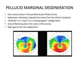 PELLUCID MARGINAL DEGENERATION
• Very steep contour in the peripheral peri-limbal cornea
• High power radiating in towards the center from the inferior meridians
• “Butterfly” or a "lazy C" or a “kissing pigeon” configuration
• Area of flattening down the center of the cornea
• High against-the-rule astigmatism.
 