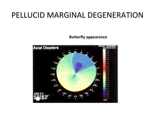 Butterfly appearence
PELLUCID MARGINAL DEGENERATION
 