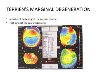 TERRIEN’S MARGINAL DEGENERATION
• prominent flattening of the corneal contour
• High against-the-rule astigmatism
 