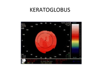 KERATOGLOBUS
 