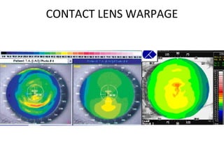 CONTACT LENS WARPAGE
 