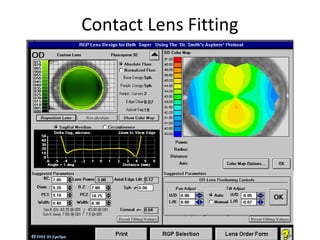 Contact Lens Fitting
 