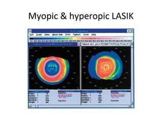 Myopic & hyperopic LASIK
 