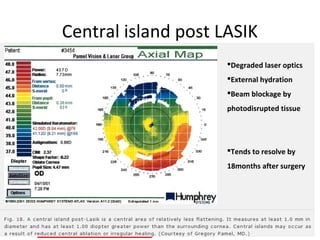Central island post LASIK
Degraded laser optics
External hydration
Beam blockage by
photodisrupted tissue
Tends to resolve by
18months after surgery
 