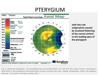 PTERYGIUM
with-the-rule
astigmatism caused
by localized flattening
of the cornea central
to the leading apex of
the pterygium
 