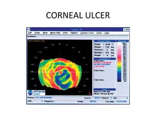 CORNEAL ULCER
 