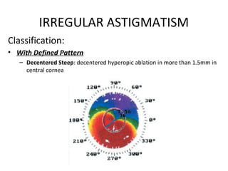 IRREGULAR ASTIGMATISM
Classification:
• With Defined Pattern
– Decentered Steep: decentered hyperopic ablation in more than 1.5mm in
central cornea
 