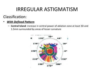 IRREGULAR ASTIGMATISM
Classification:
• With Defined Pattern
– Central Island: increase in central power of ablation zone at least 3D and
1.5mm surrounded by areas of lesser curvature
 