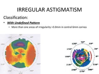 IRREGULAR ASTIGMATISM
Classification:
• With Undefined Pattern
– More than one areas of irregularity >3.0mm in central 6mm cornea
 