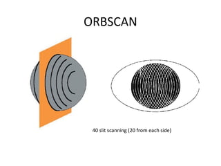 ORBSCAN
40 slit scanning (20 from each side)
 