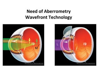 Need of Aberrometry
Wavefront Technology
 