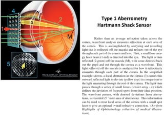 Type 1 Aberrometry
Hartmann Shack Sensor
 