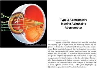 Type 3 Aberrometry
Ingoing Adjustable
Aberrometer
 