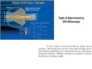 Type 4 Aberrometry
Slit Skiascopy
 