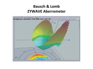 Bausch & Lomb
ZYWAVE Aberrometer
 