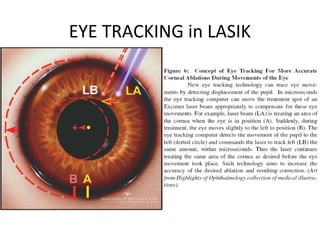 EYE TRACKING in LASIK
 