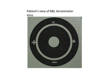 Patient’s view of B&L keratometer
mire
 