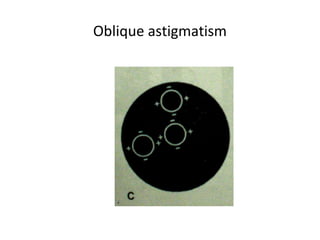Oblique astigmatism
 