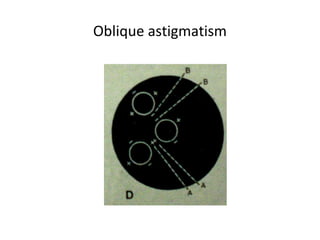Oblique astigmatism
 