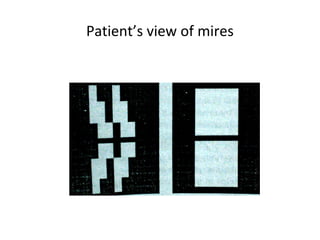 Patient’s view of mires
 