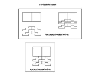 Vertical meridian
Unapproximated mires
Approximated mires
 