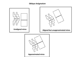 Oblique Astigmatism
Unaligned mires Aligned but unapproximated mires
Approximated mires
 