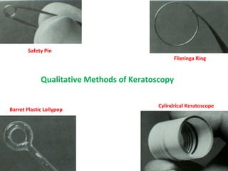Safety Pin
Flieringa Ring
Barret Plastic Lollypop
Cylindrical Keratoscope
Qualitative Methods of Keratoscopy
 